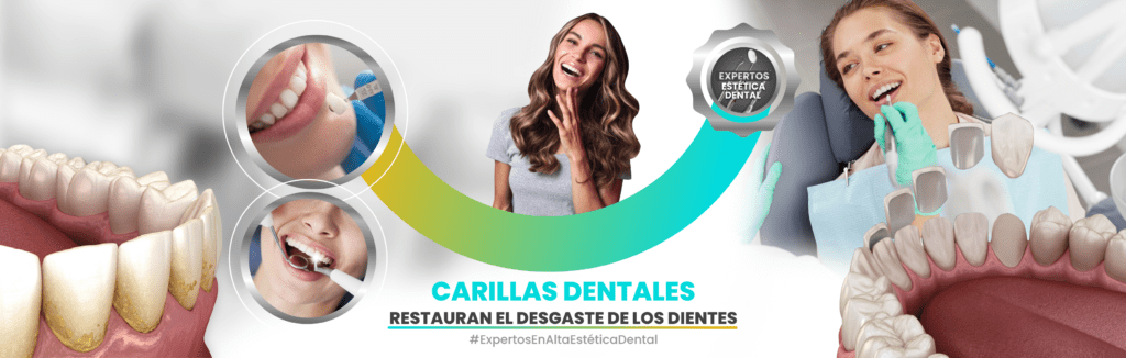 Carillas Dentales - iDental