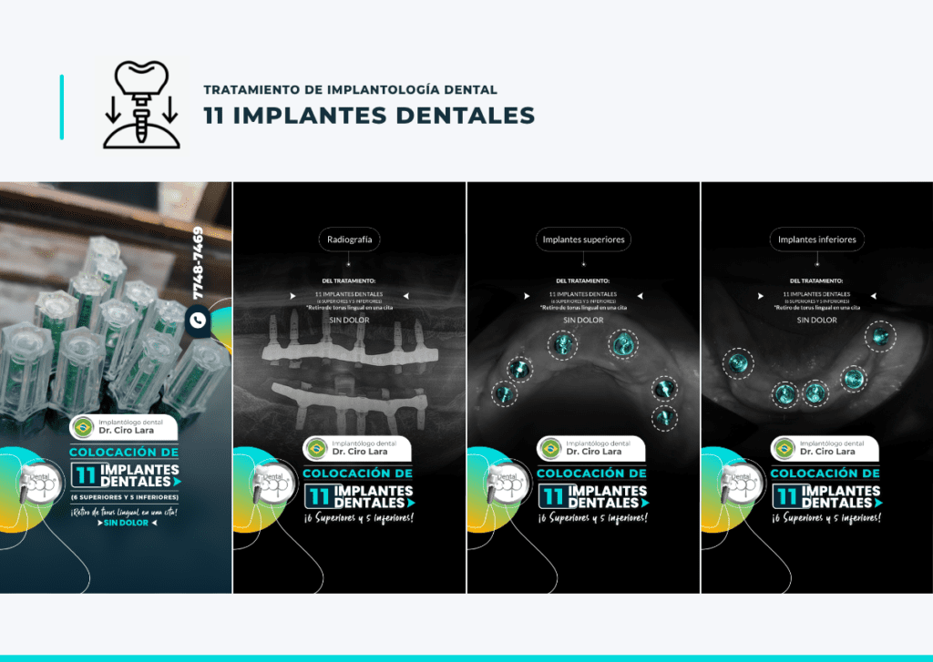 Implantes dentales de zirconio y titanio, De que material están hechos los implantes dentales