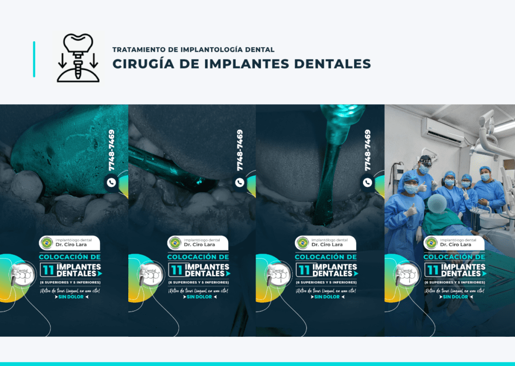 Cirugías de implantes dentales y sus riesgos