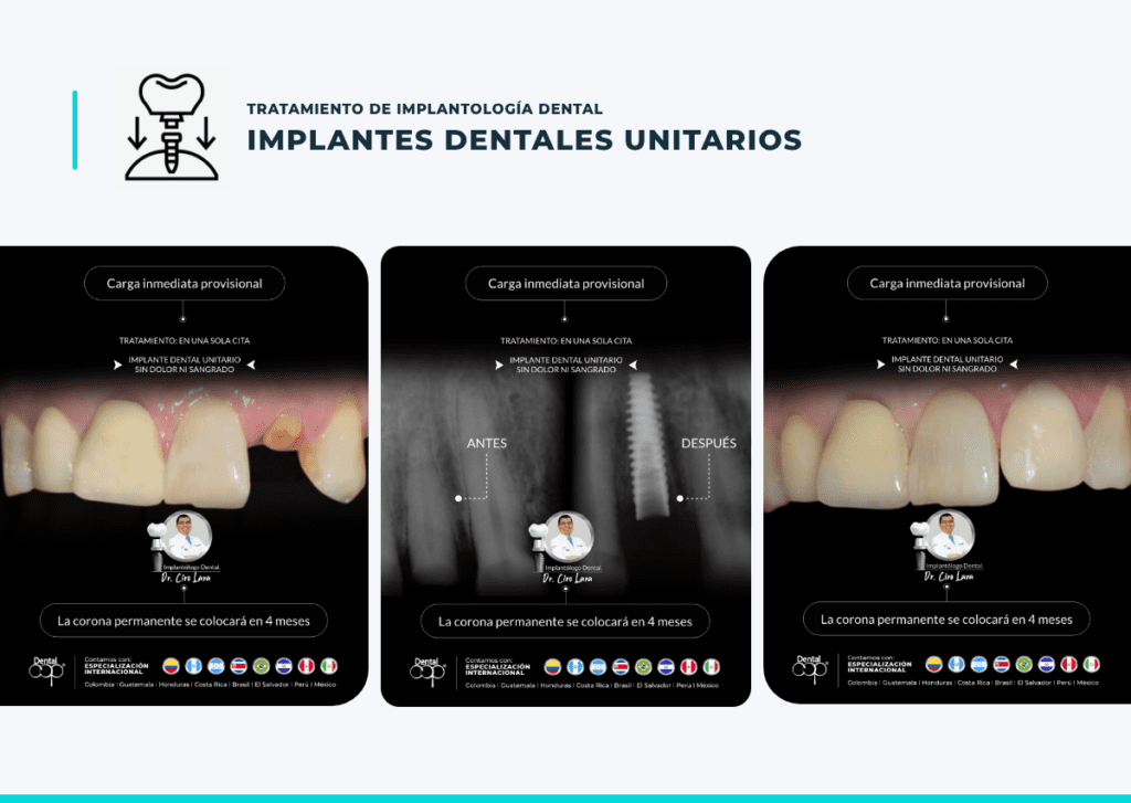DentalCOP implantes dentales unitarios, clinica dental de implantologia ofrece grandes beneficios al paciente portador de implantes dentales