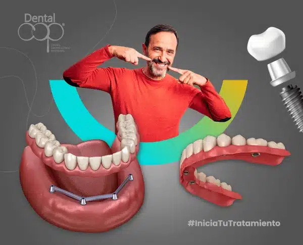 Servicio dental de Implantes dentales all on 4