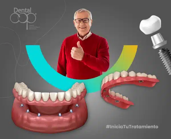 Servicio dental de implantología dental all on 6